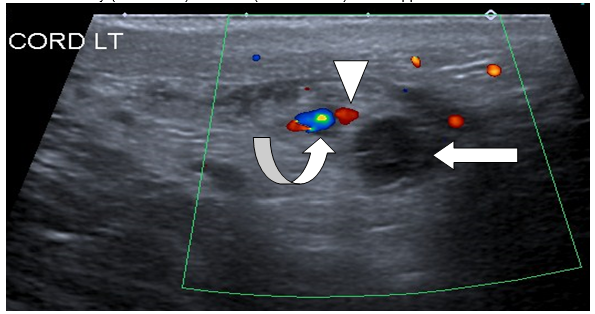 A Rare Cause of Testicular Pain: Thrombosis of the Pampiniform Plexus ...