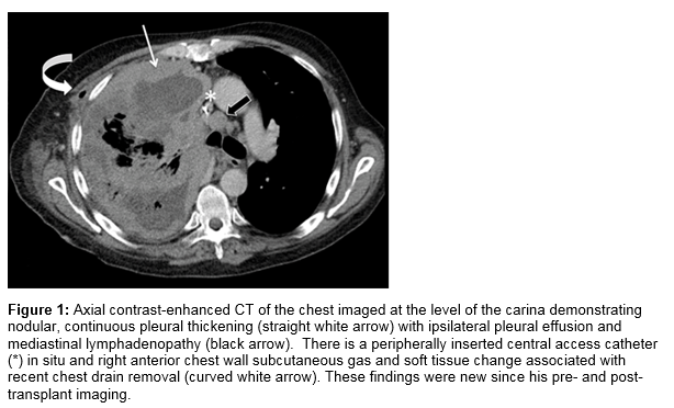 cancer of bronchus metastatic to bone and brain icd 10