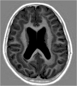 Band Heterotopia: An unusual cause of seizures – Irish Medical Journal