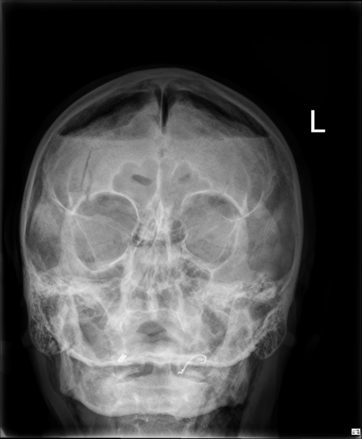 Post Traumatic Tension Pneumocephalus The Mount Fuji Sign Irish Medical Journal