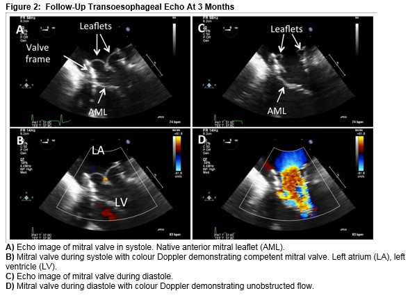 Surgical prosthetic valves | Thoracic Key