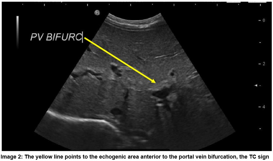 The Triangular Sign, a Useful Diagnostic Marker for ...