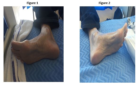 Plantar hot sale fibromatosis causes